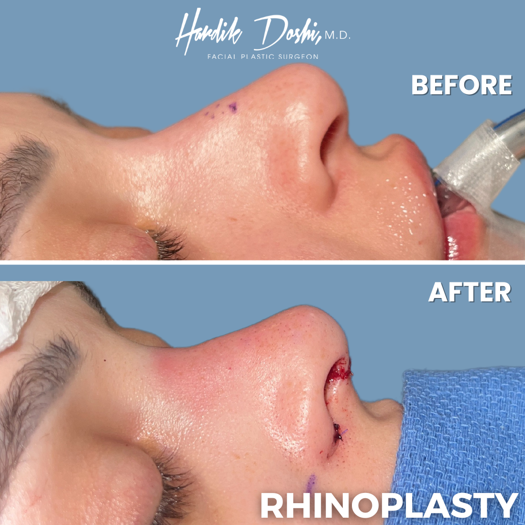 Mouth Breathing After Rhinoplasty: What to Expect