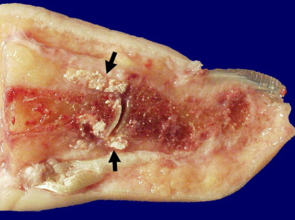 Pictures of Gout Crystals: Quick Visual Guide