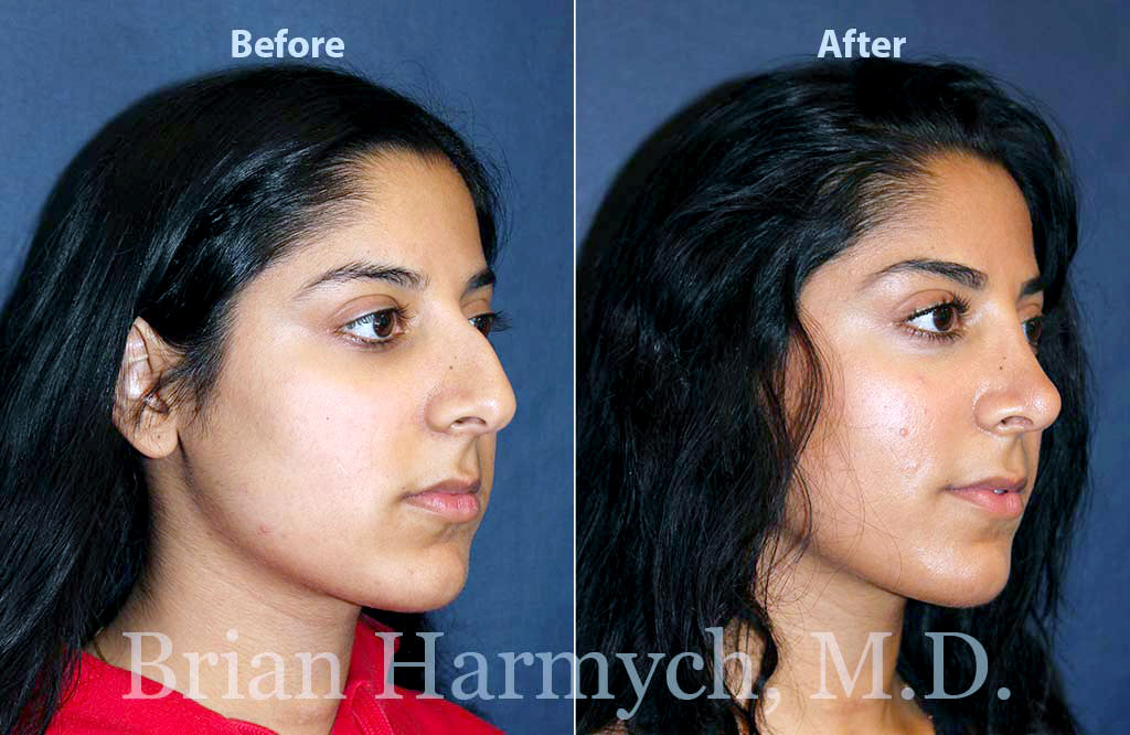 Rhinoplasty Cost: What You Really Pay for a Nose Job