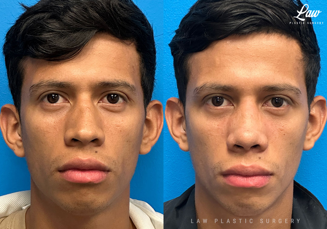 Septoplasty Before and After: Real Results & Recovery