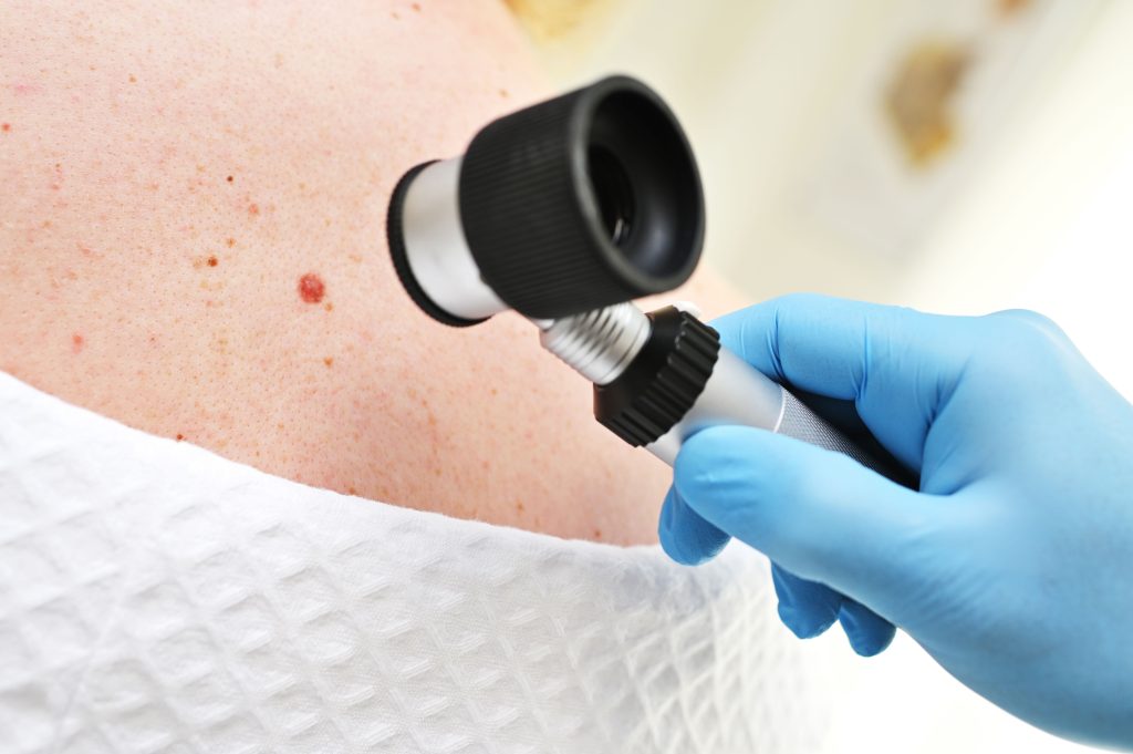 Skin Cancer Treatment: Options, Success & Expect