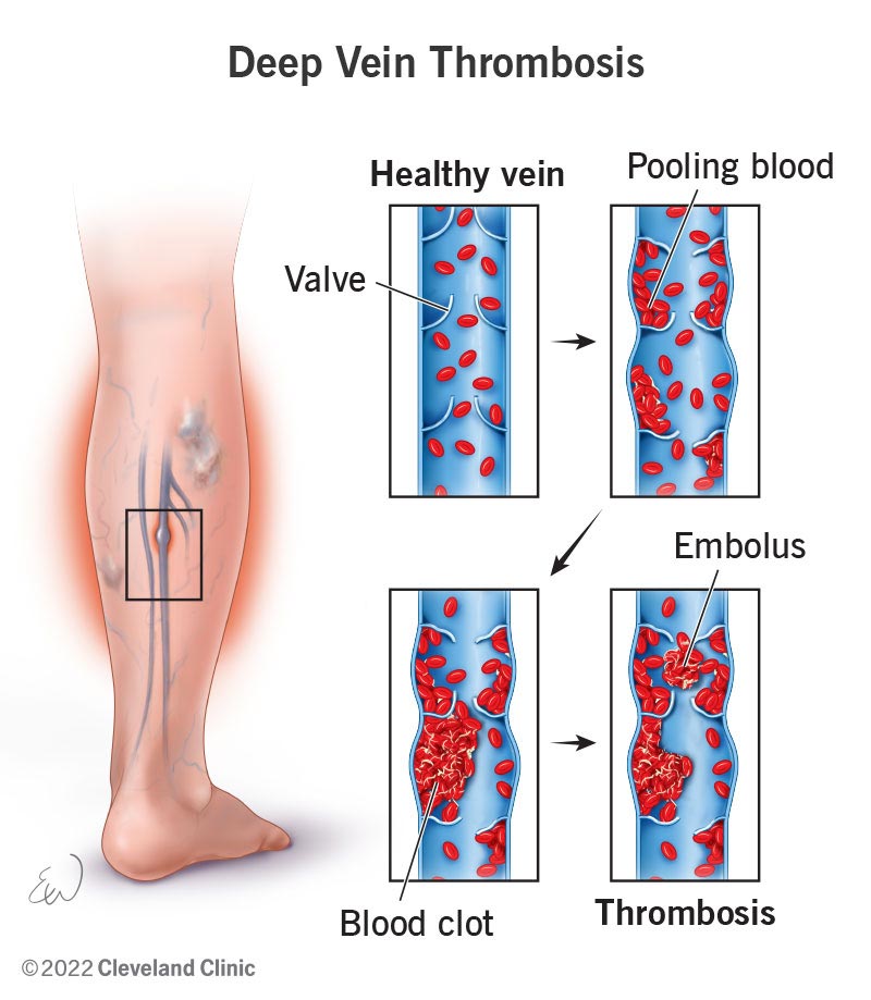 Types of Blood Clots in Legs: What You Need to Know