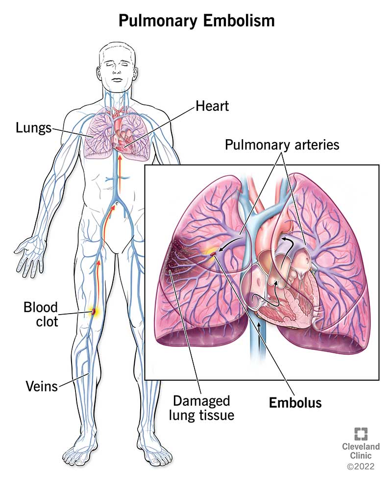 Types of Blood Clots in Lungs: What You Need to Know