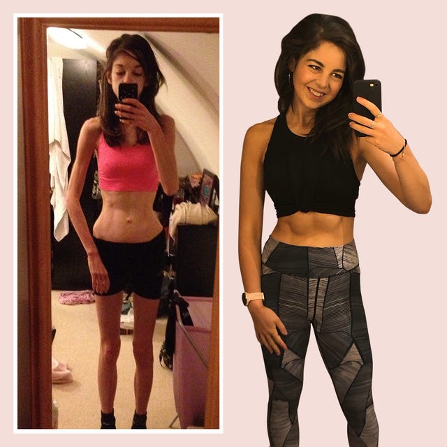 I Reversed My Osteoporosis: 6‑Month Life‑Changing Plan