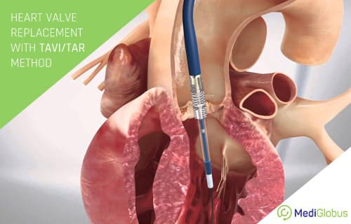 TAVR Procedure Cost in USA – What You Need to Know