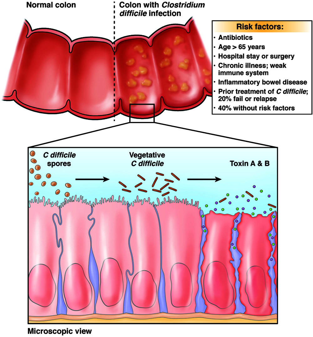 c diff colitis: symptoms, causes, treatment guide