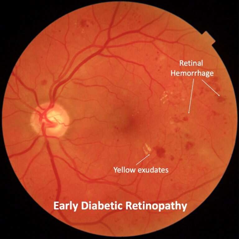Early Diabetic Retinopathy: Signs, Risks & Action Steps