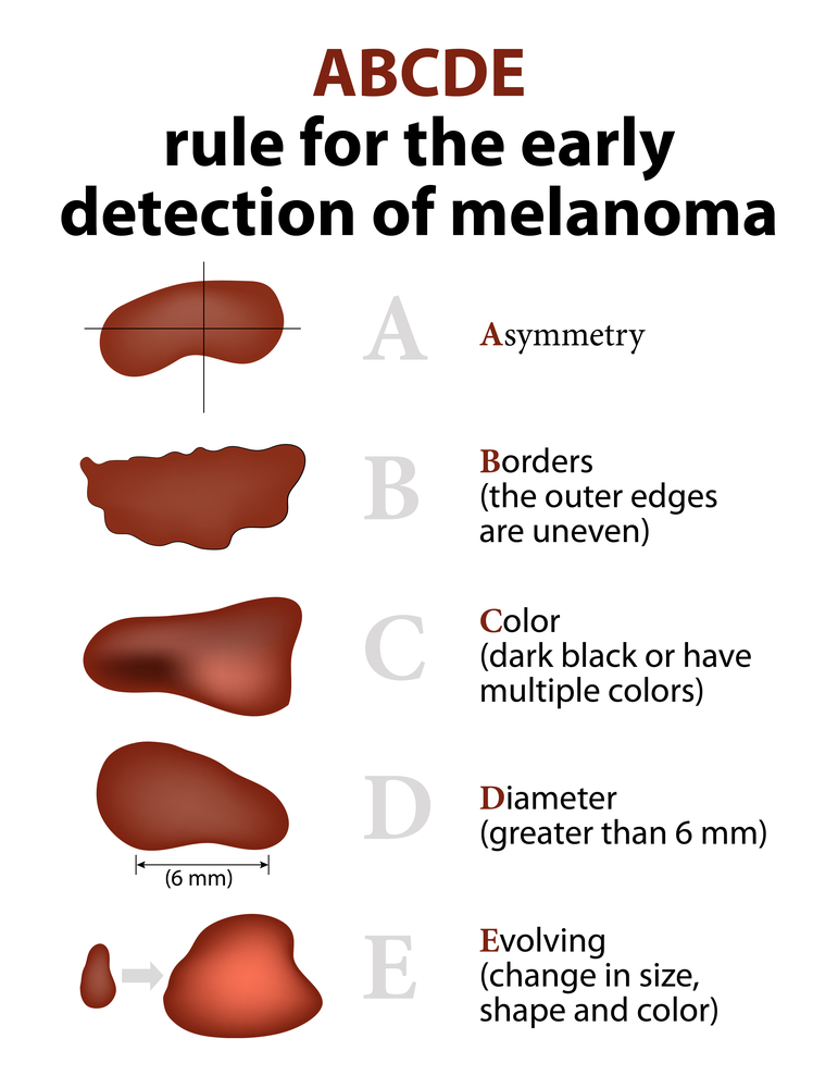 Melanoma Detection: Spot Early Signs & Take Action