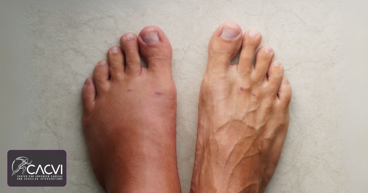 Why Is My Left Leg Swollen Bigger Than My Right Leg?