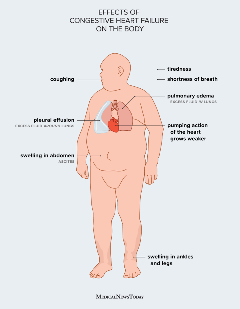 Congestive Heart Failure Swelling Abdomen Treatment Guide