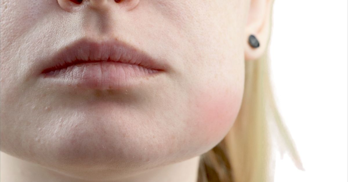 How to Reduce Swelling on Face – Fast, Safe Relief