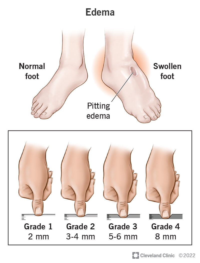 How to Treat Edema: Quick, Safe Ways to Reduce Swelling