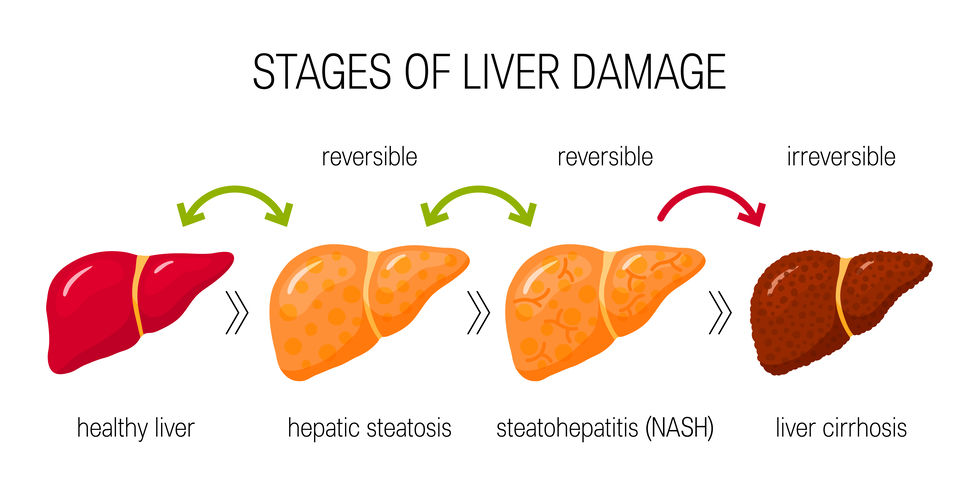 Is Fatty Liver Reversible? Your Complete Guide