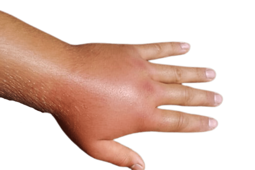 One Swollen Hand: Causes, Relief & When to Seek Help