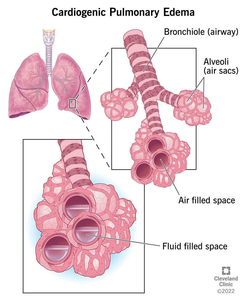 Pulmonary Edema Congestive Heart Failure Life Expectancy
