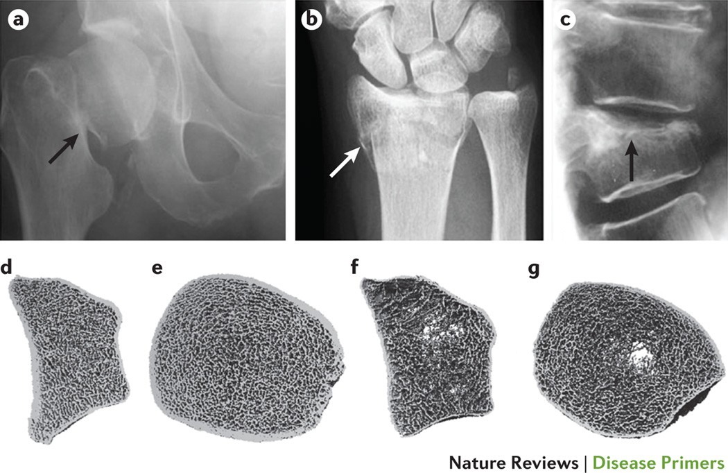 Can You Safely Reverse Osteoporosis in 6 Months?