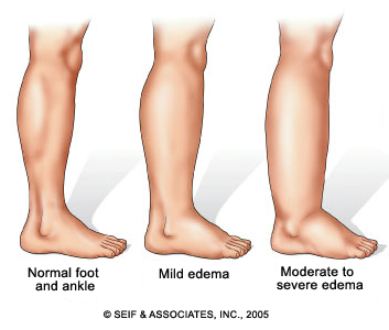 Swelling in One Leg – 7 Causes & Quick Relief Guide