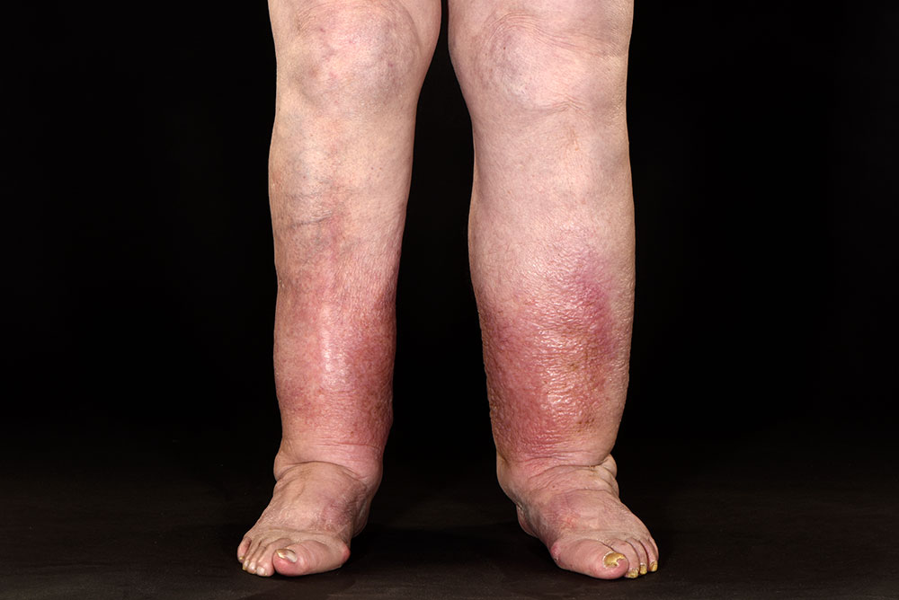 Swollen Legs in Elderly Female: Causes & Relief