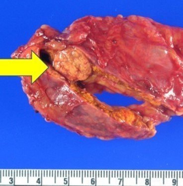 10 mm Left Adrenal Nodule: What It Means for You