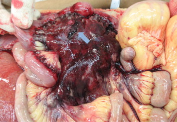 Acute Myeloid Leukemia Death Process: Signs & Care