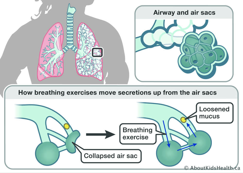 Airway Clearance Techniques for Cystic Fibrosis