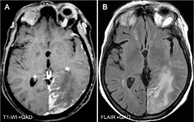 AML Brain Metastasis: What It Is and What It Means