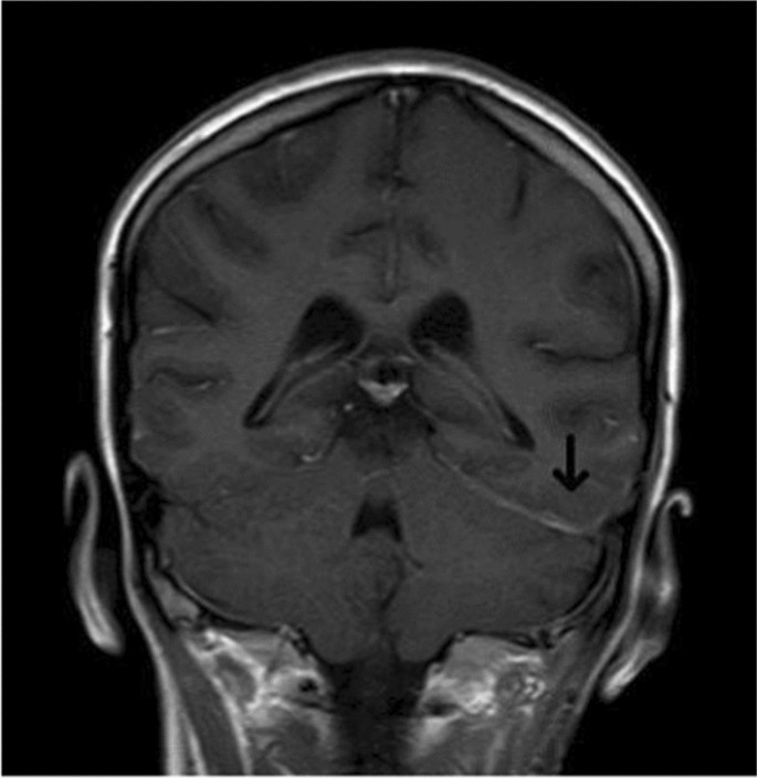 AML with CNS Involvement Treatment Guide for Families