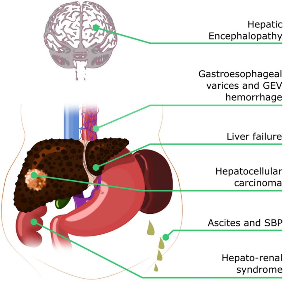 Can Portal Hypertension Be Reversed? Answers & Hope