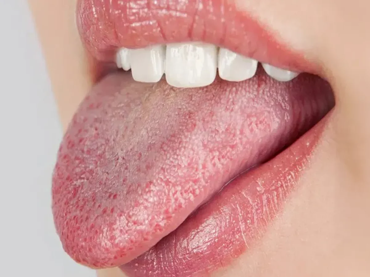 Dry Mouth in the Morning Diabetes: Causes & Relief