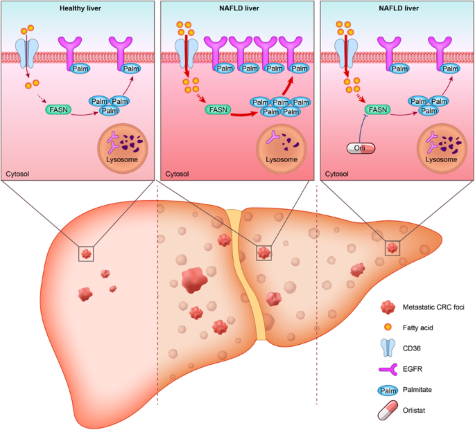 Fatty Liver After Chemotherapy: Key Facts & Care