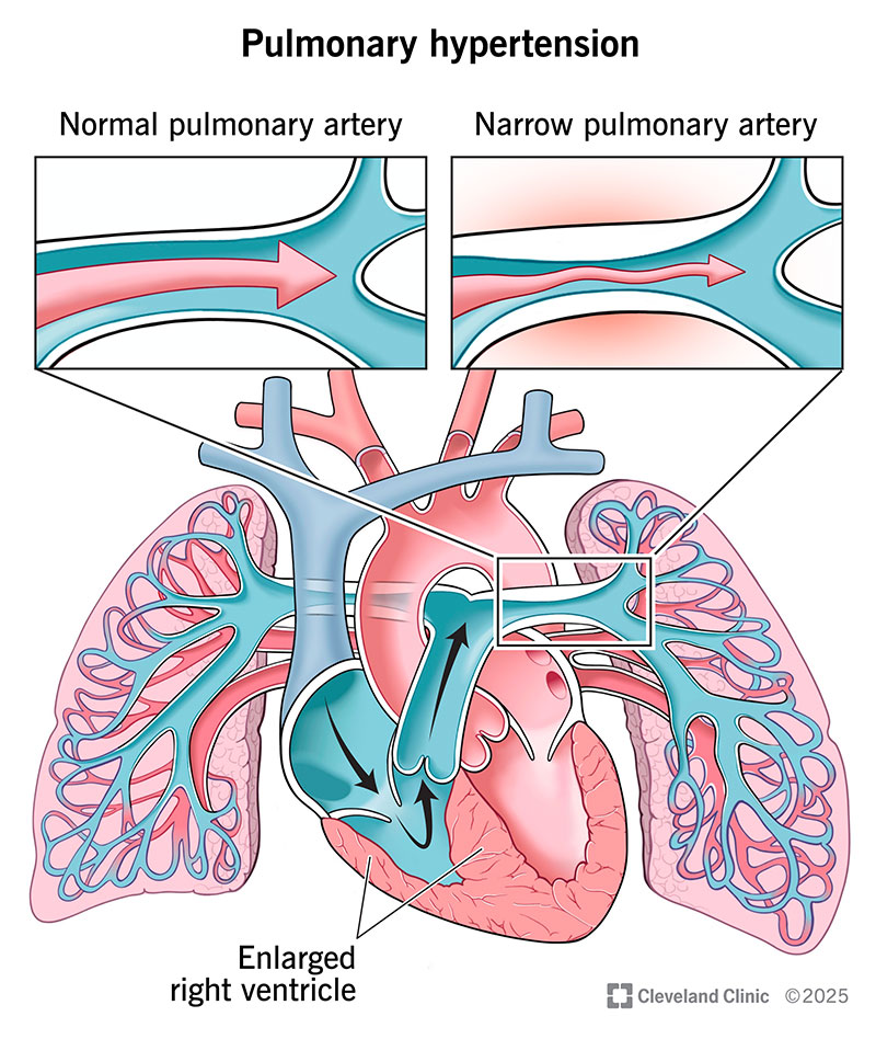 High Pulmonary Artery Pressure: Meaning & Management