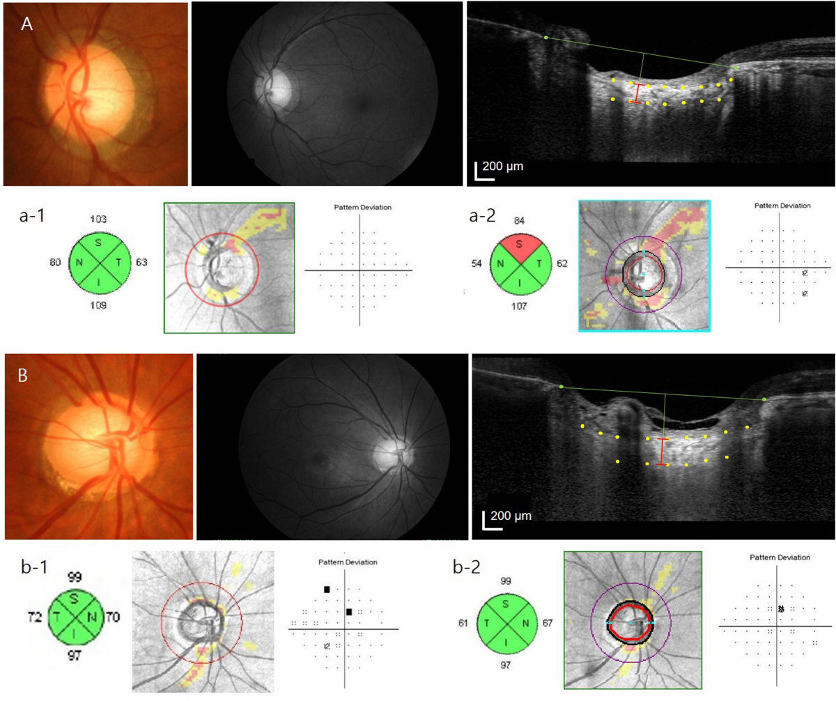 How Fast Does Normal‑Tension Glaucoma Progress?