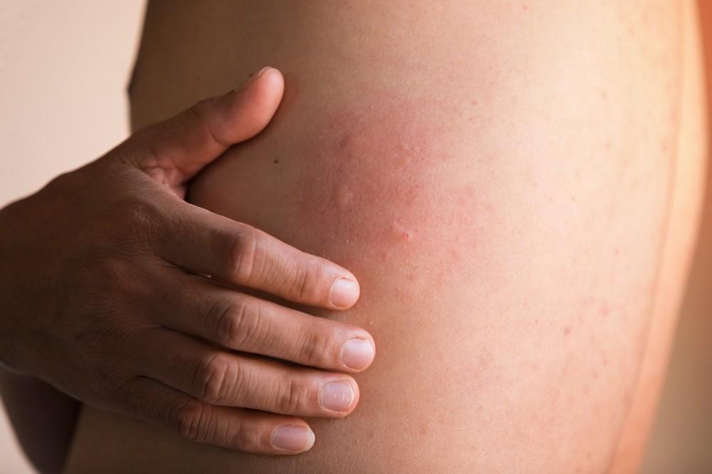 How to Cure Urticaria Permanently, Naturally for You