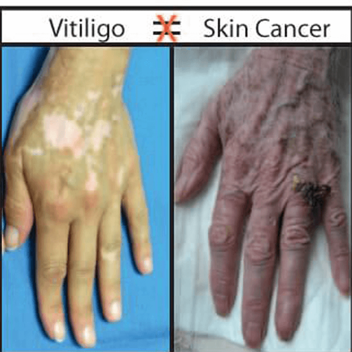 Is Vitiligo Dangerous? Risks, Myths & Answers