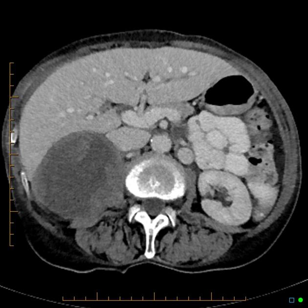 Most Common Metastasis to Adrenal Gland: Quick Answers