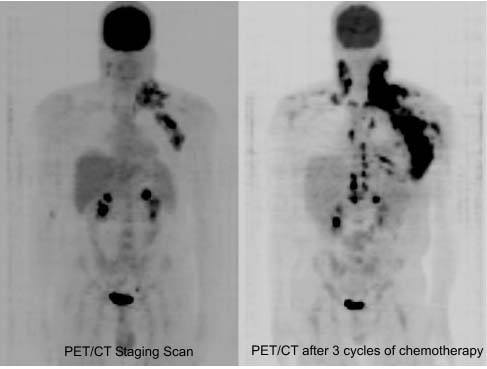 Pet Scan After Chemo for Lymphoma: Your Guide