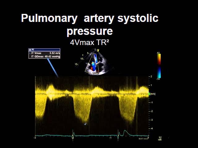 Pulmonary Artery Pressure Echo: Measure & Interpret