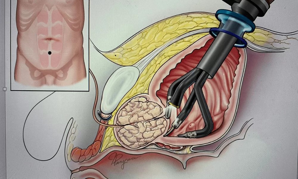 Robotic Simple Prostatectomy Recovery Time Explained
