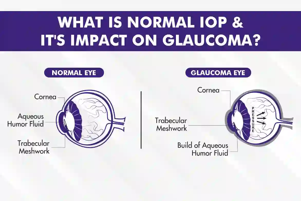 Top Treatment for Glaucoma with Normal Eye Pressure