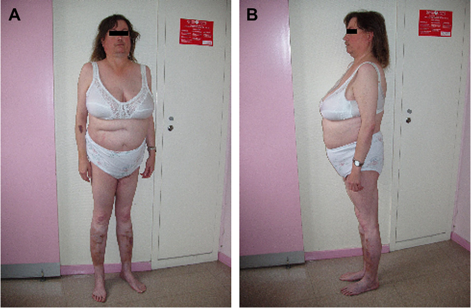 Truncal Obesity and Thin Extremities: Causes & Care