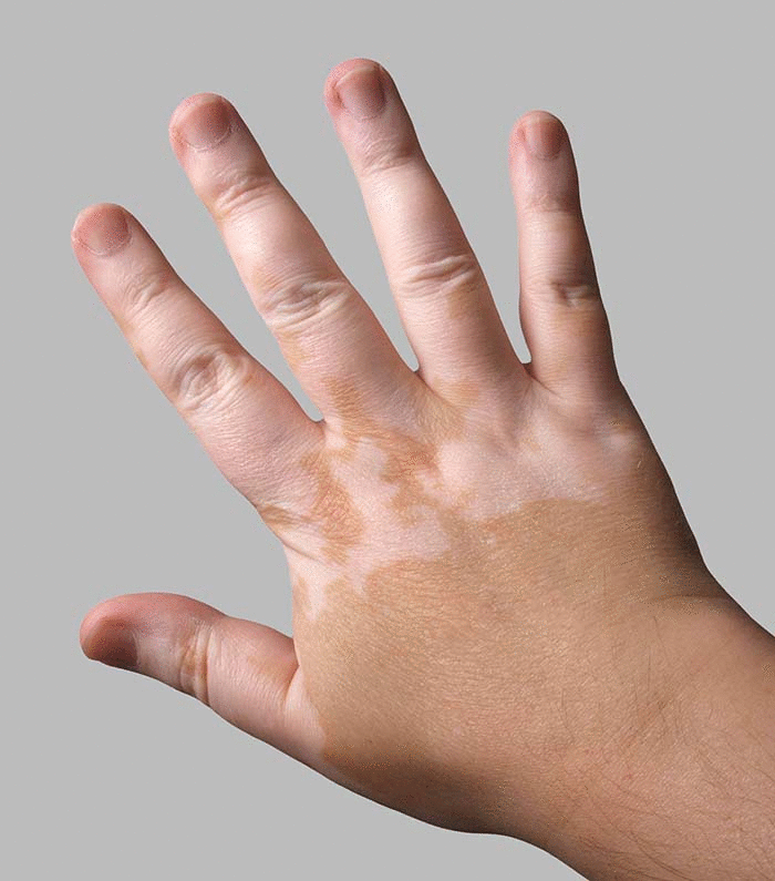 Vitiligo Symptoms – Spot the Signs and What Comes Next