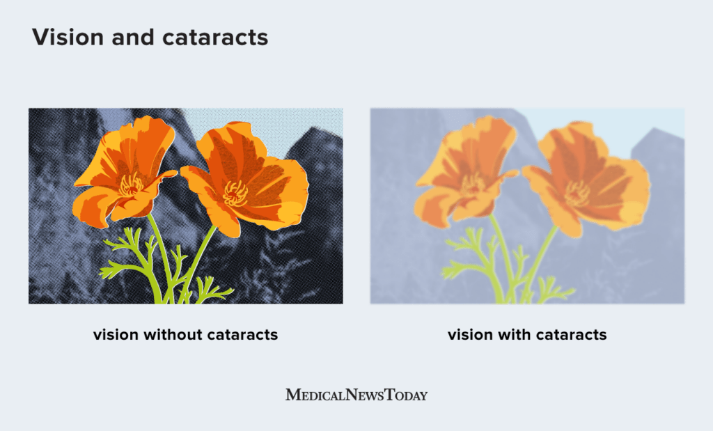 What Does Vision Look Like With Cataracts? Guide