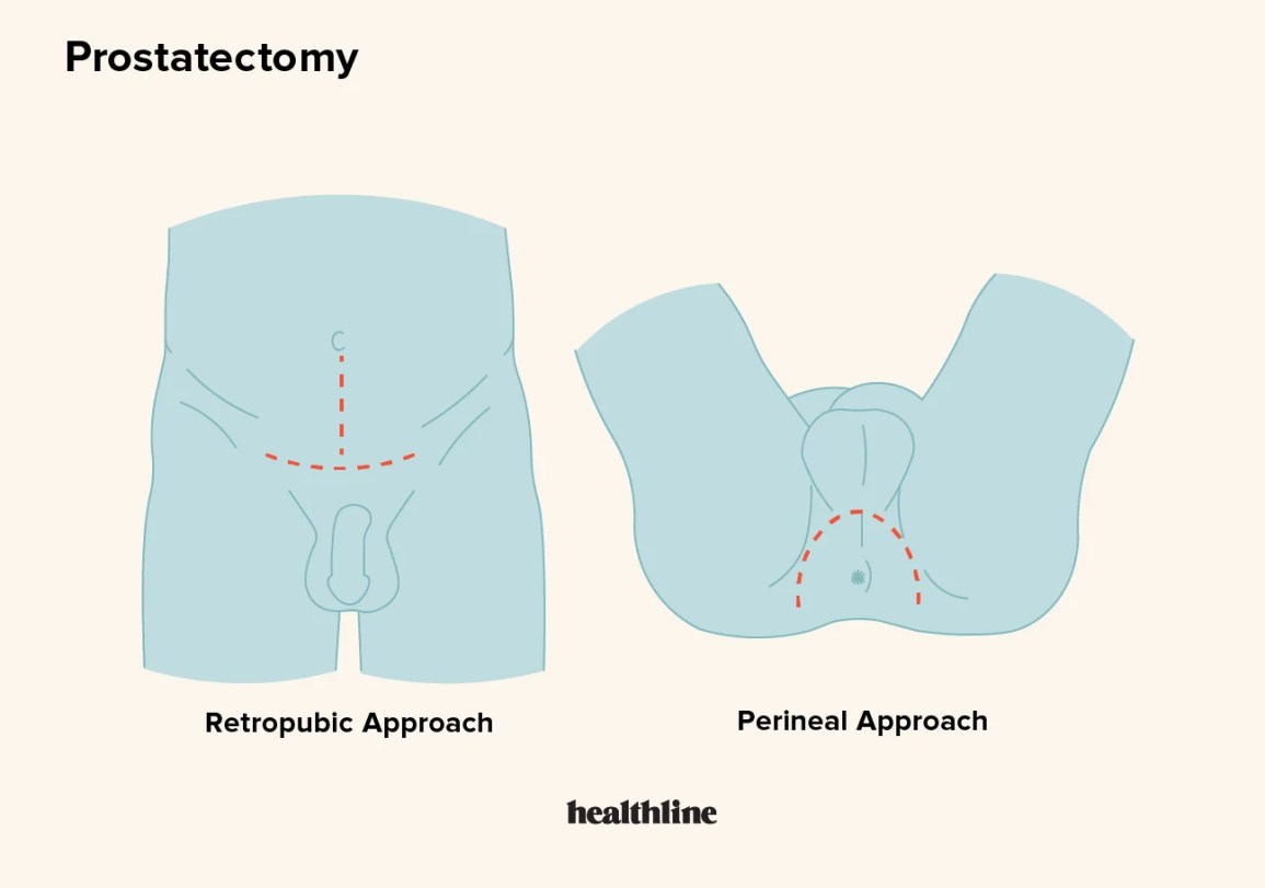 What Is the Most Common Problem After Prostatectomy?