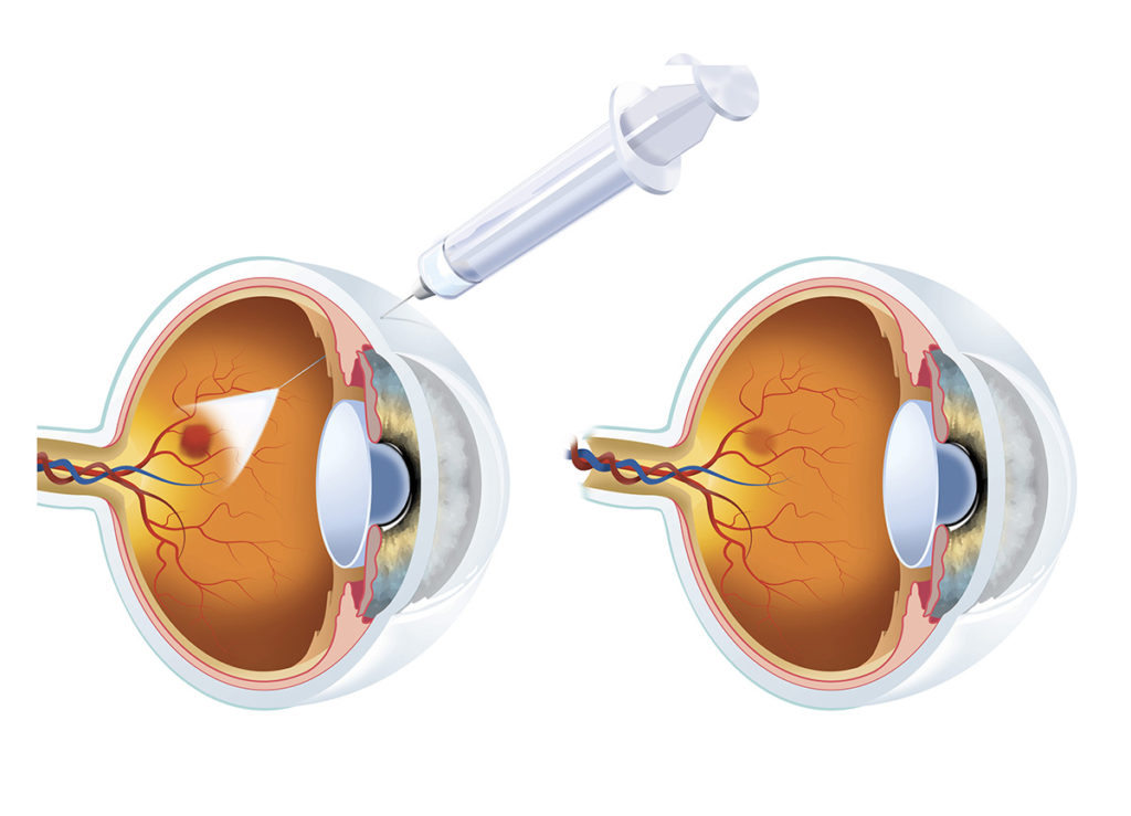 Avastin vs Eylea for Diabetic Retinopathy: What’s Best?