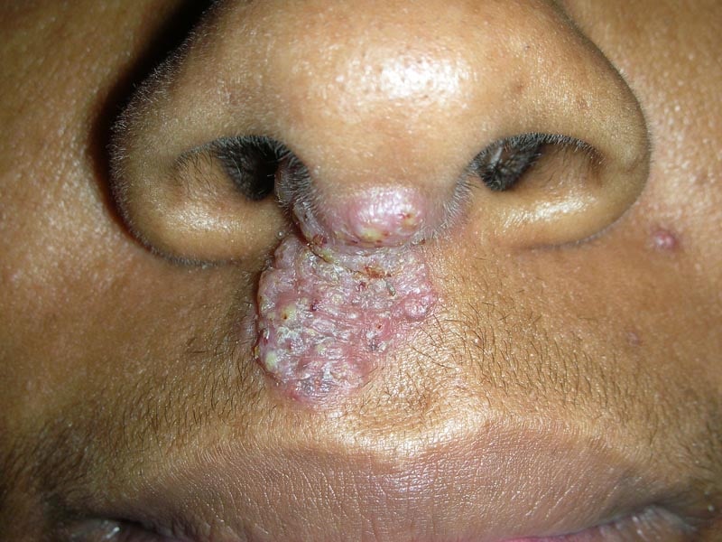 Blastomycosis Symptoms Skin: What to Watch For