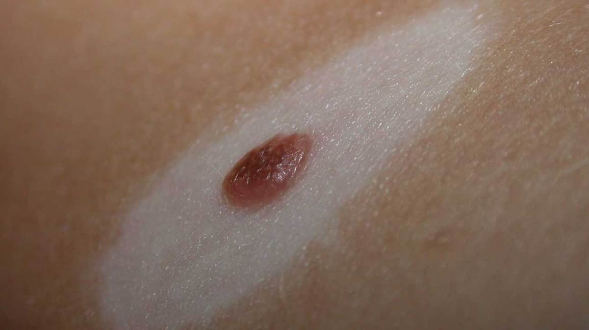 Brown Mole With White Spot In Middle – What It Means