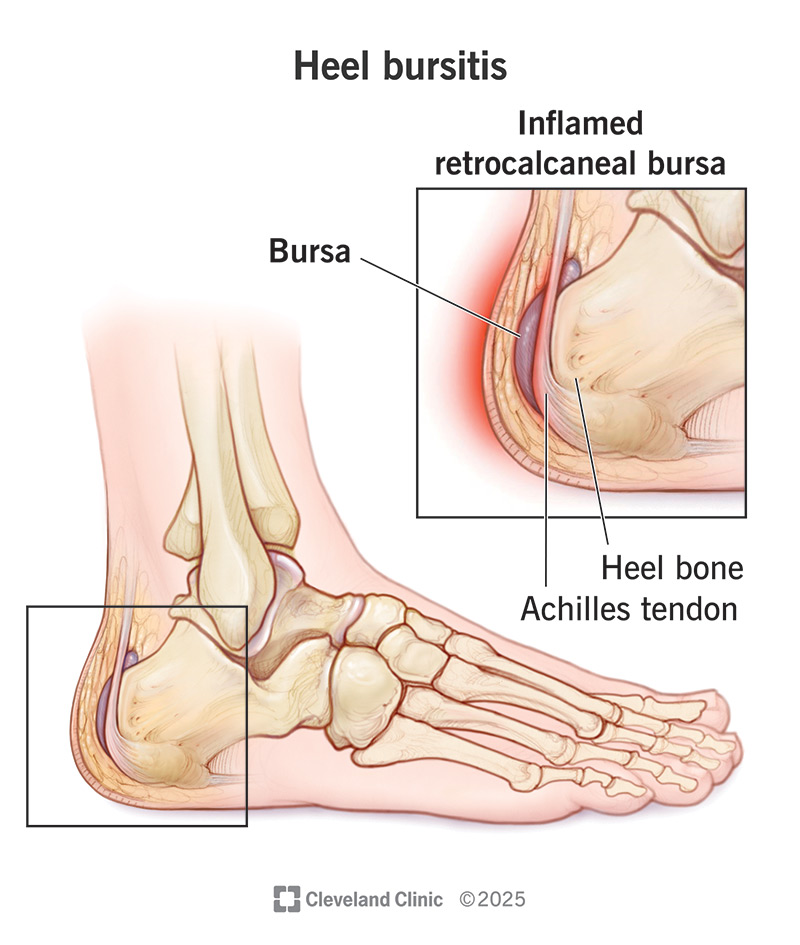 Bursitis Gout Heel Relief: Fast Answers & Easy Steps