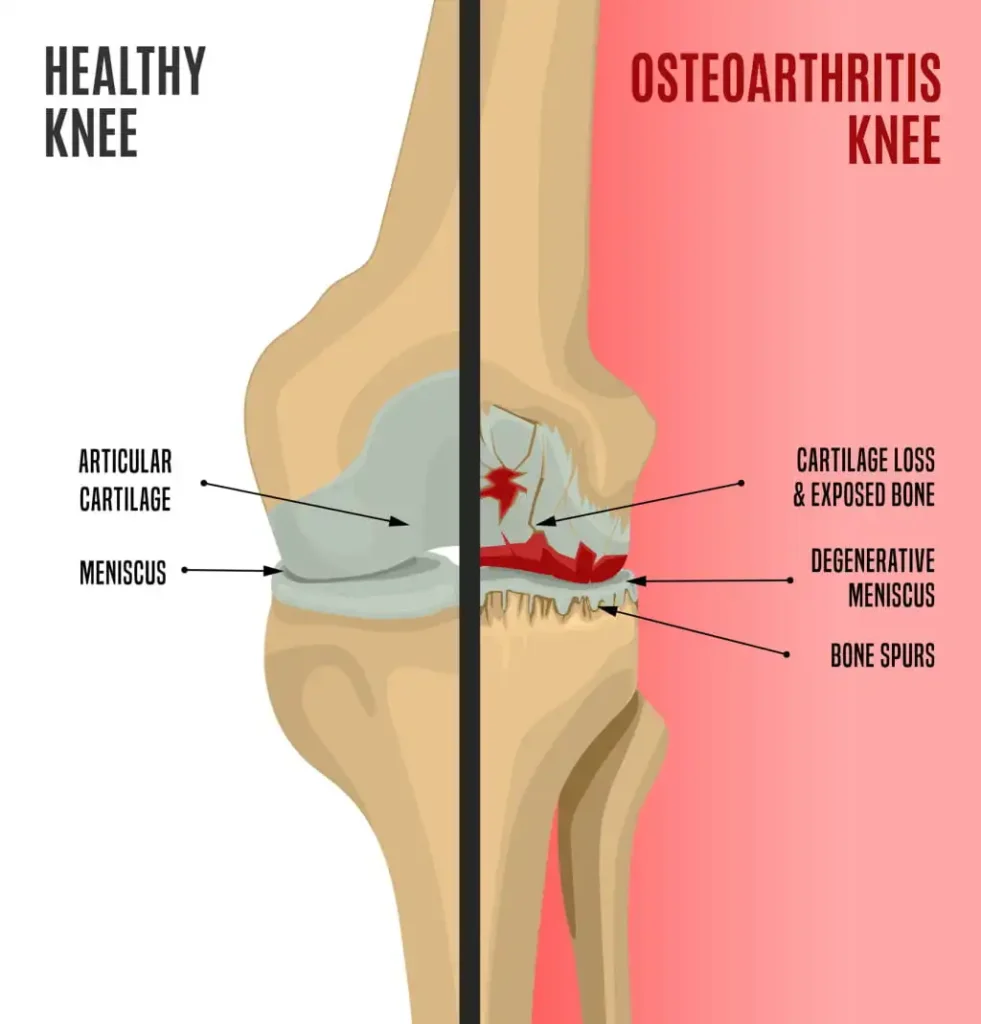 Can I Get Disability for Arthritis in My Knees?