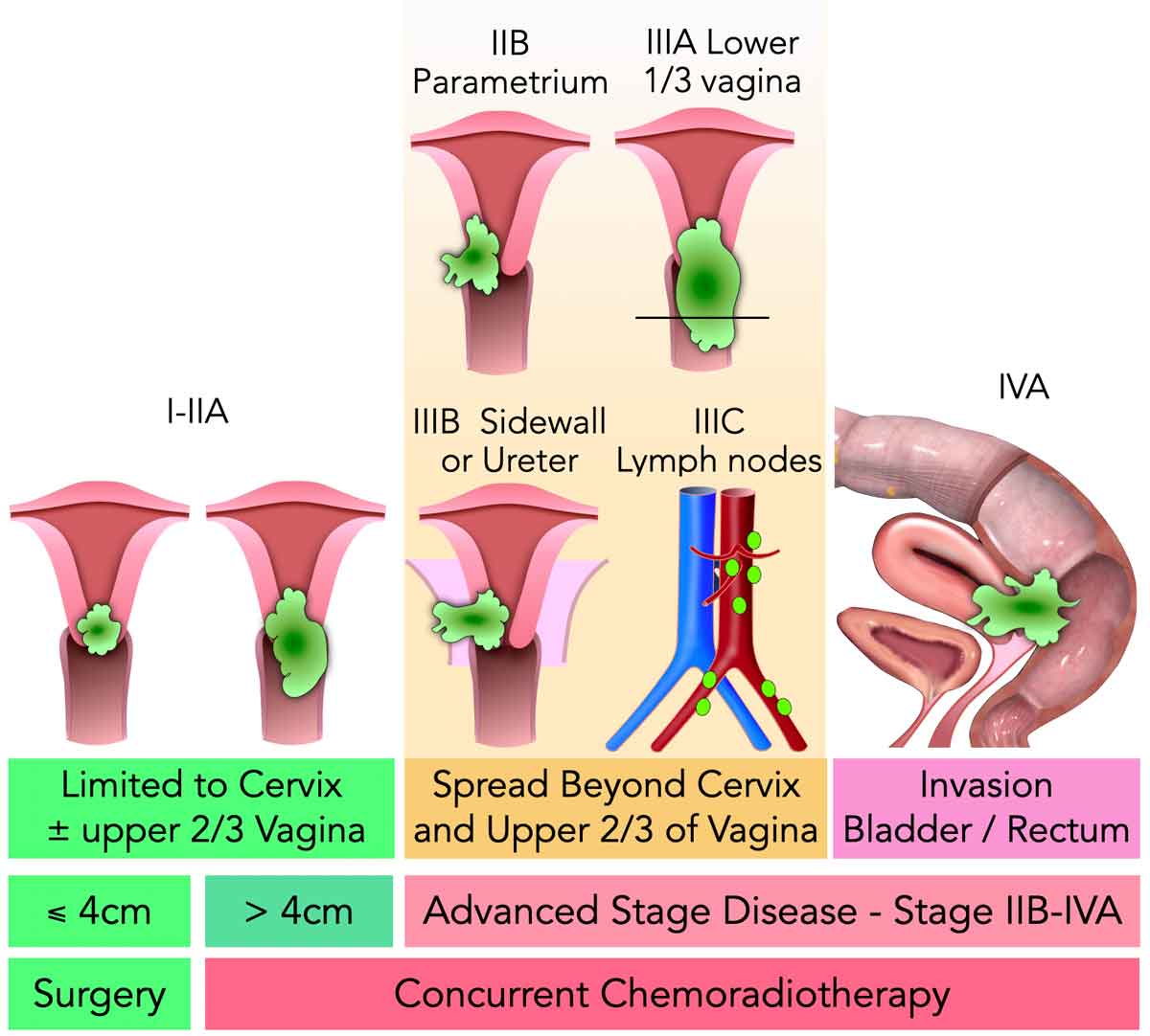 Cervical Cancer Radiology Assistant: Fast MRI Staging