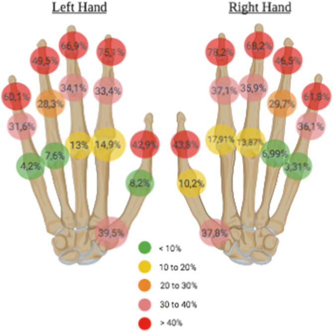 Chances of Getting Disability for Arthritis in Hands